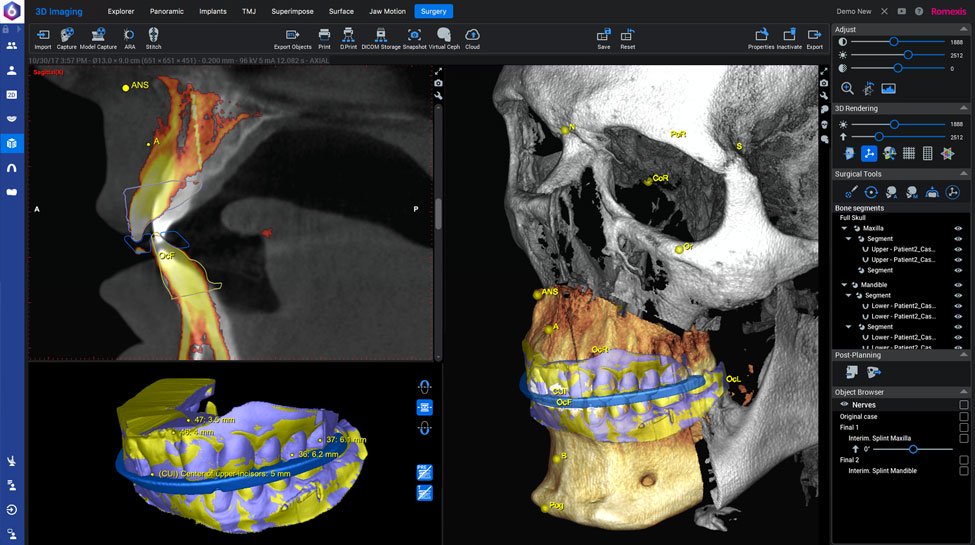Romexis® CMF Surgery