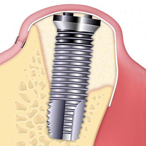 OsteoBiol® Evolution