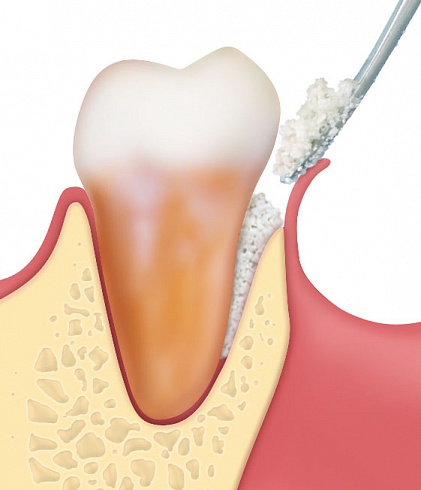 OsteoBiol® Gen-Os