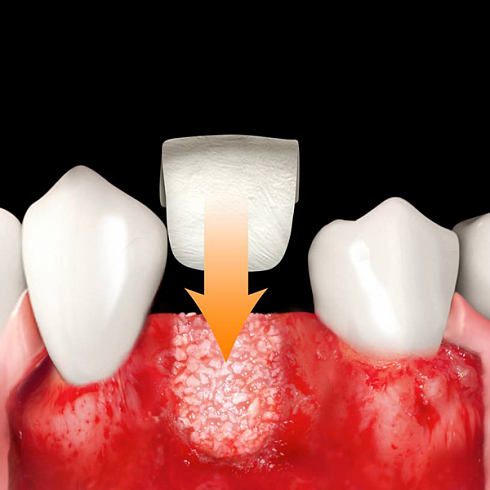 OsteoBiol® Lamina