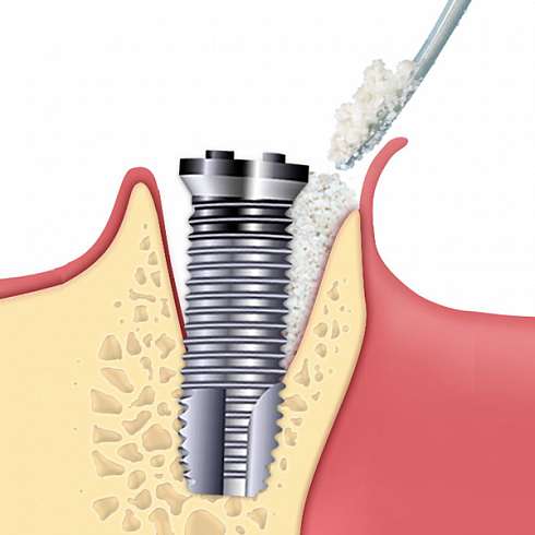 OsteoBiol® Apatos Cortical