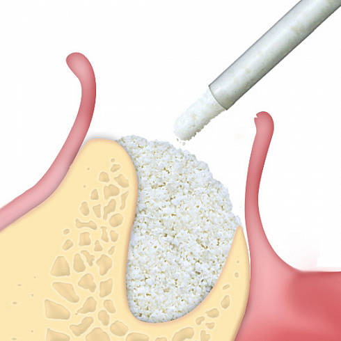OsteoBiol® GTO
