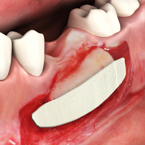 OsteoBiol® Evolution