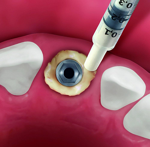 OsteoBiol® Putty