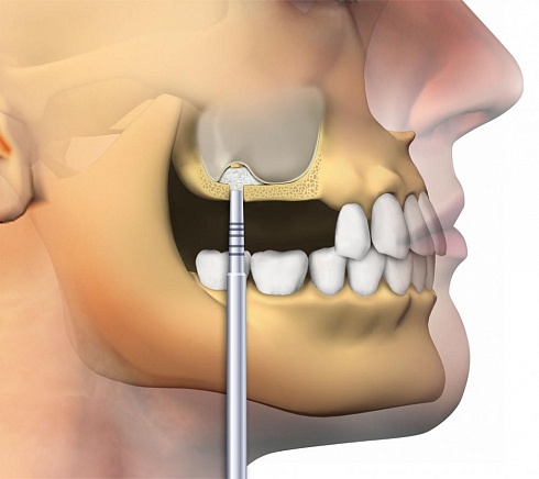 OsteoBiol® Gen-Os