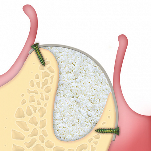 OsteoBiol® Lamina
