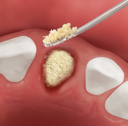 OsteoBiol® Gen-Os