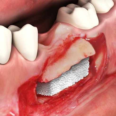 OsteoBiol®  Sp-Block