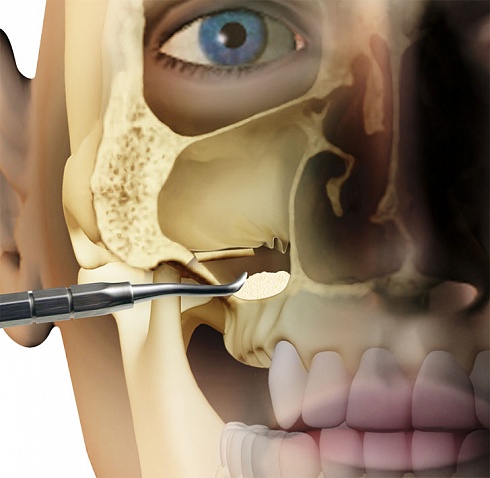 OsteoBiol® Gen-Os